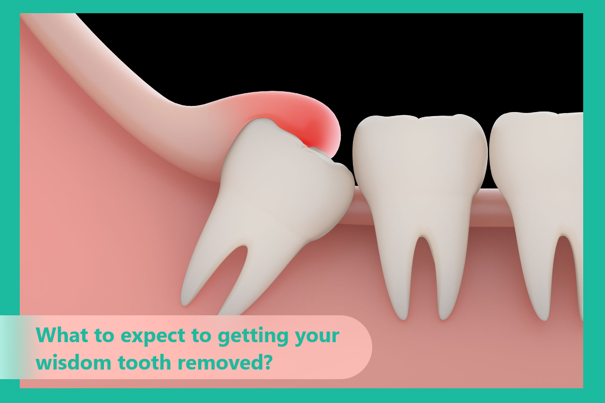 What to expect when getting your Wisdom Tooth removed?